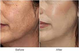 Best Skin Doctor for Pigmentation in Indore